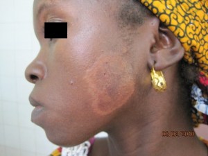 Lepra en Sierra Leone