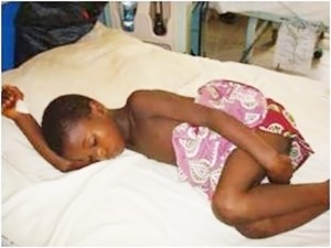 Día mundial del paludismo